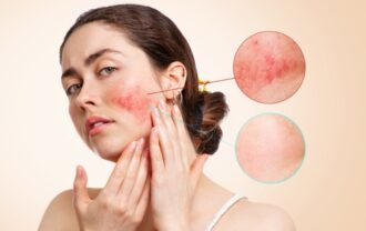 What Causes and Triggers Rosacea?
